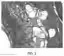 Fig. 04 - IMPLANTABLE DRUG-LOADED DEVICE