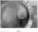 Fig. 06 - Implants having a drug load of an oxysterol and methods of use