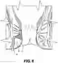 Fig. 07 - WOUND TREATMENT DEVICE