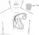 Fig. 01 - Hemostatic devices and methods of use