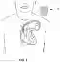 Fig. 02 - Hemostatic devices and methods of use
