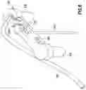 Fig. 06 - CATHETER INSERTION DEVICE AND METHOD OF INSERTING A CATHETER