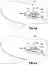Fig. 48 - CATHETER INSERTION DEVICE AND METHOD OF INSERTING A CATHETER