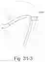 Fig. 87 - Delivery of respiratory therapy using collapsible inlet conduits
