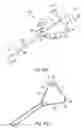 Fig. 47 - Ureteral and Bladder Catheters and Methods of Inducing Negative Pressure to Increase Renal Perfusion