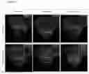 Fig. 09 - Method of using multichannel stimulation system for regenerating damaged corneal nerves
