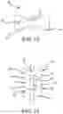 Fig. 08 - Flexible high-density mapping catheter tips and flexible ablation catheter tips with onboard high-density mapping electrodes