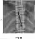 Fig. 19 - Methods of implanting a stimulation lead for stimulation of a dorsal root ganglion