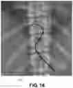 Fig. 20 - Methods of implanting a stimulation lead for stimulation of a dorsal root ganglion