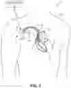 Fig. 02 - Battery assembly for medical device