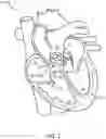 Fig. 02 - Devices and Methods for cardiac pacing and resynchrontzation