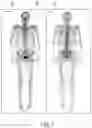 Fig. 07 - Systems and methods for automated and interactive analysis of bone scan images for detection of metastases