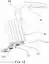 Fig. 14 - Implant positioner and sternal plating system