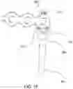 Fig. 15 - Implant positioner and sternal plating system