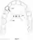 Fig. 06 - MODIFIED MAXILLARY SKELETAL RAPID EXPANDER DEVICE AND METHOD