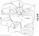 Fig. 51 - Method and apparatus for minimally invasive insertion of intervertebral implants