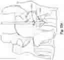 Fig. 52 - Method and apparatus for minimally invasive insertion of intervertebral implants
