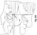 Fig. 53 - Method and apparatus for minimally invasive insertion of intervertebral implants