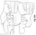Fig. 55 - Method and apparatus for minimally invasive insertion of intervertebral implants