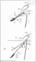 Fig. 01 - INSECT CATCHING TOOL
