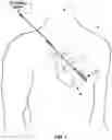 Fig. 02 - Sensing for heart failure management
