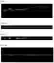 Fig. 07 - 3-dimensional measurement method for eye movement and fully automated deep-learning based system for vertigo diagnosis