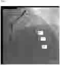 Fig. 05 - AUTOMATIC DISPLAY OF PREVIOUSLY-ACQUIRED ENDOLUMINAL IMAGES