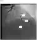Fig. 06 - AUTOMATIC DISPLAY OF PREVIOUSLY-ACQUIRED ENDOLUMINAL IMAGES