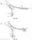 Fig. 16 - Suture passing device
