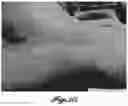 Fig. 21 - MICROSTRUCTURE-BASED WOUND CLOSURE DEVICES