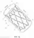 Fig. 14 - METHOD AND APPARATUS FOR TREATING A PATIENT BY INTENTIONALLY OCCLUDING A BLOOD VESSEL, INCLUDING METHOD AND APPARATUS FOR INDUCING WEIGHT LOSS IN A PATIENT BY INTENTIONALLY OCCLUDING THE CELIAC ARTERY