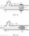 Fig. 08 - Low radial force vascular device and method of occlusion