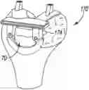 Fig. 01 - Method of designing and manufacturing low-profile customized patient-specific orthopaedic surgical instruments
