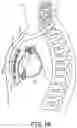 Fig. 03 - Systems and methods for deploying an implantable medical electrical lead