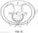 Fig. 04 - Systems and methods for deploying an implantable medical electrical lead