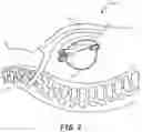 Fig. 05 - Systems and methods for deploying an implantable medical electrical lead