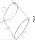 Fig. 04 - Protector for a Trans-Corneal Incision