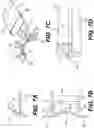 Fig. 08 - Protector for a Trans-Corneal Incision