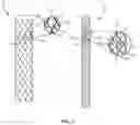 Fig. 04 - Spinal implant system and method