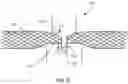 Fig. 06 - Spinal implant system and method