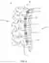 Fig. 07 - Spinal implant system and method