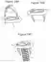 Fig. 20 - Bone implants