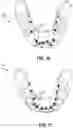 Fig. 13 - Dental appliances and associated methods of manufacturing