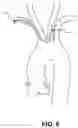 Fig. 07 - Intravascular blood filter