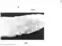 Fig. 08 - STENT GRAFT