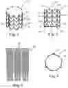 Fig. 02 - Stents for Prosthetic Heart Valves