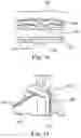 Fig. 07 - Stents for Prosthetic Heart Valves