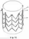 Fig. 10 - Stents for Prosthetic Heart Valves