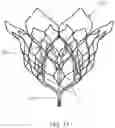 Fig. 13 - Prosthetic Mitral Valves And Apparatus And Methods For Delivery Of Same