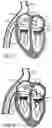 Fig. 02 - Fluid diversion devices for hydraulic delivery systems and associated methods